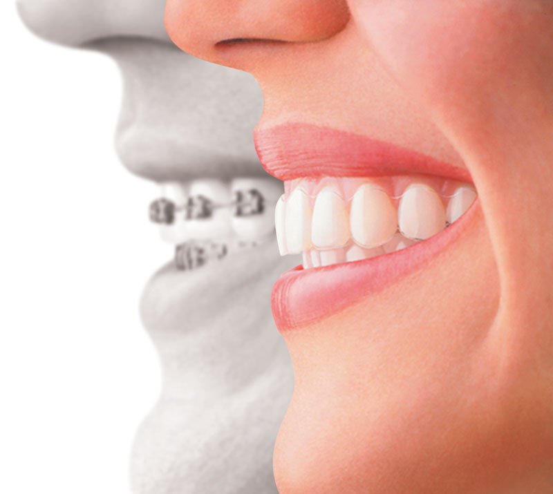 Invisalign profiles