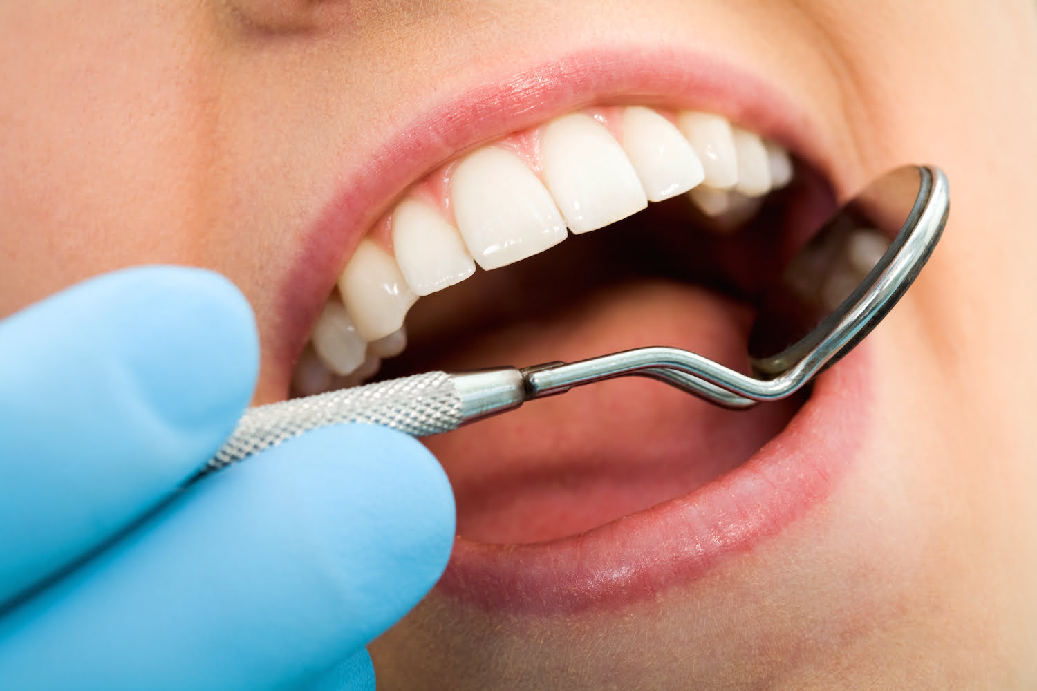 Image result for dental plaque